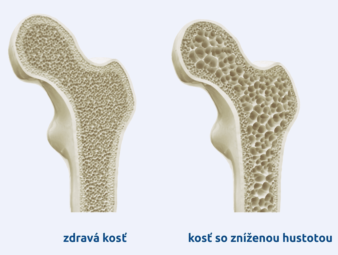 Demineralizácia kostí - zdravá vs. kosť so zníženou hustotou
