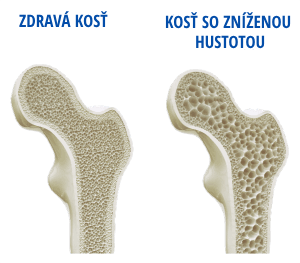 Rozdiel medzi zdravou kosťou a kosťou so zníženou hustotou
